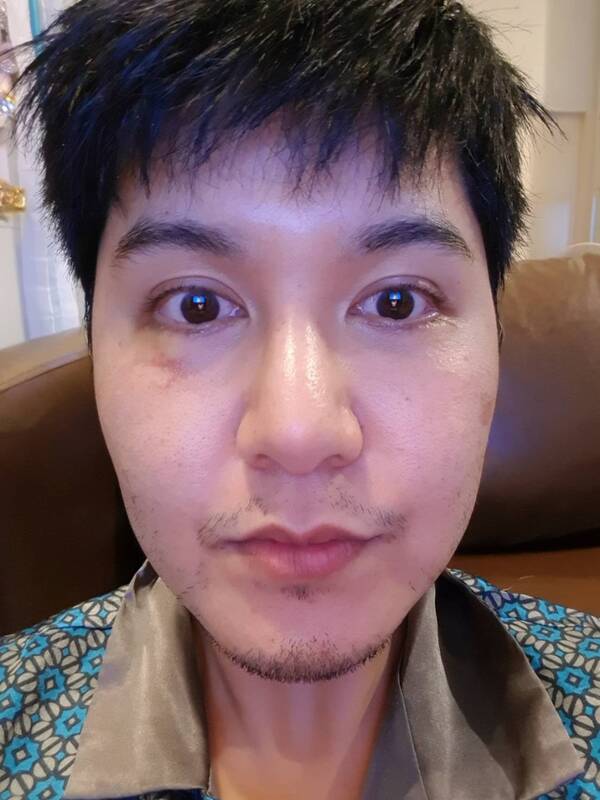ตัดถุงใต้ตา 12_5_23 (5).jpg