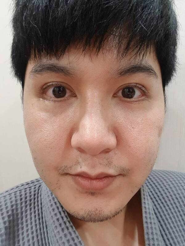 ตัดถุงใต้ตา 12_5_23 (6).jpg