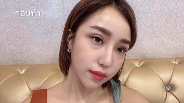 ตัดถุงใต้ตา 22.9 (15).jpg