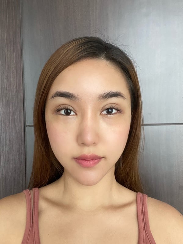 ตัดถุงใต้ตา 22.9 (16).jpg