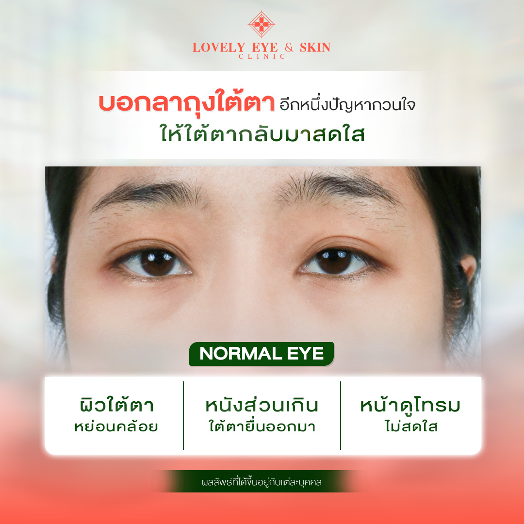 เทคนิคผ่าตัดถุงใต้ตาหมอรวงข้าวเหมาะกับใคร