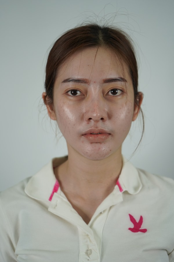 ทำตาสองชั้น ดึงกล้ามเนื้อตา 19_5_23 (10)_0.JPG