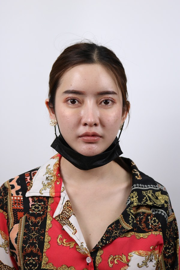 ทำตาสองชั้น ดึงกล้ามเนื้อตา 19_5_23 (5).JPG