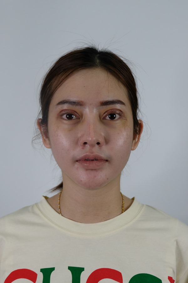 ทำตาสองชั้น ดึงกล้ามเนื้อตา 19_5_23 (6).JPG