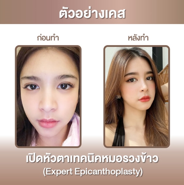ทำตาสองชั้น หมอรวงข้าว akeru (7).jpg