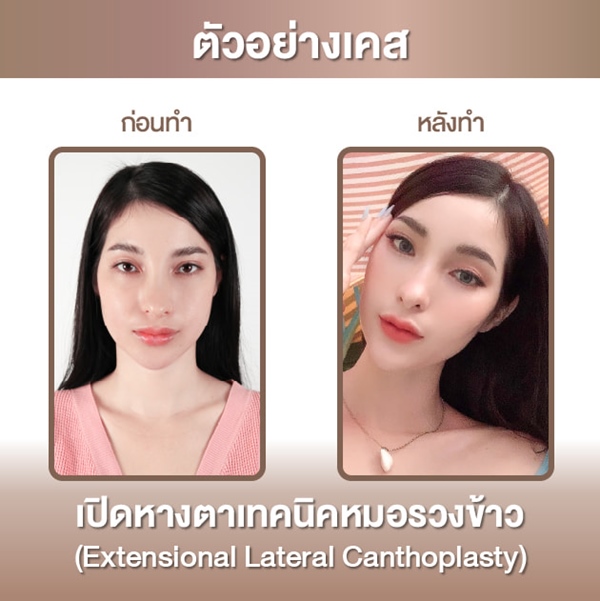 ทำตาสองชั้น หมอรวงข้าว akeru (8).jpg