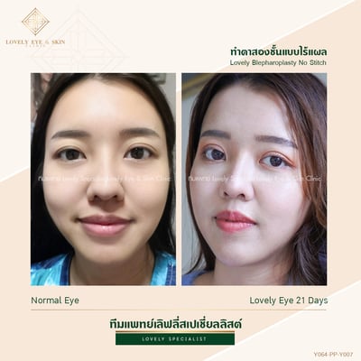 ทำตาสองชั้น เทคนิคหมอรวงข้าว 12.jpg