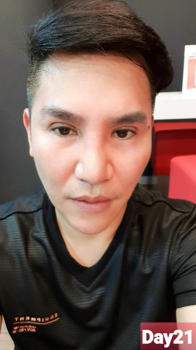 หลังทำตาสองชั้น 21 วัน ชั้นตาดูเป็นธรรมชาติ
