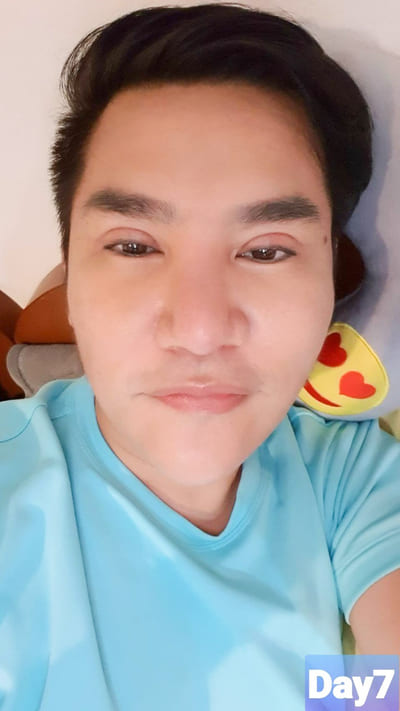 หลังทำตาสองชั้น 7 วัน เส้นชั้นตาจะดูบางลงจากช่วงแรกๆ