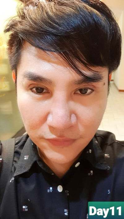 หลังทำตาสองชั้น 11 วัน ตัดไหมแล้ว รู้สึกโล่ง สบายตา