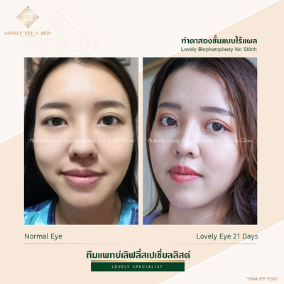 ทำตาสองชั้น เทคนิคหมอรวงข้าว 44 (2).jpg