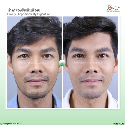 ทำตาสองชั้น เทคนิคหมอรวงข้าว37 (1).png