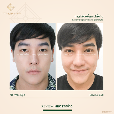 ทำตาสองชั้น เทคนิคหมอรวงข้าว37 (2).png
