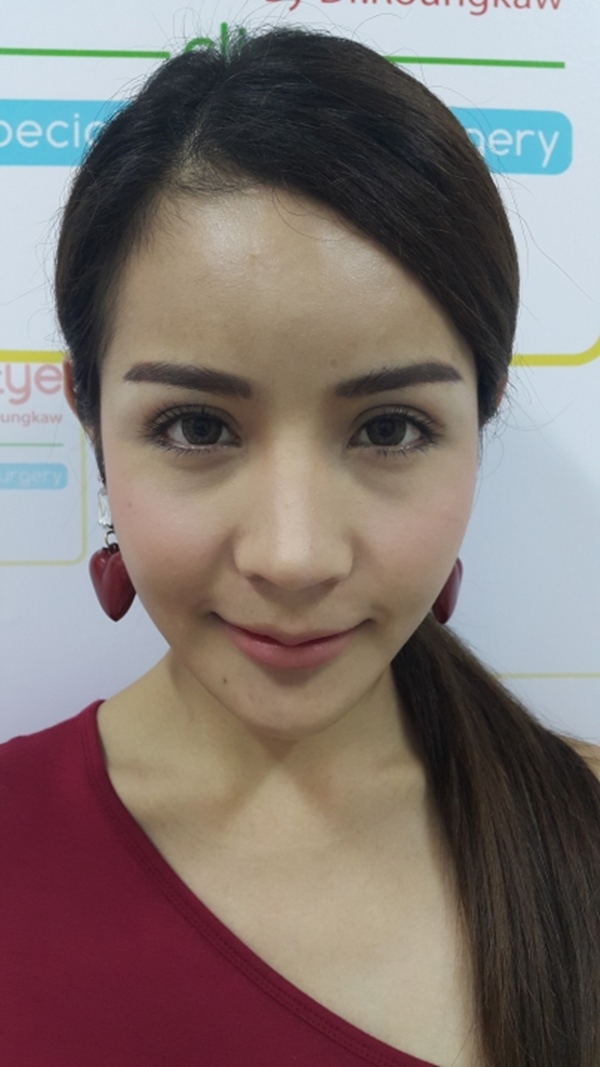ทำตาสองชั้น เปิดหัวตา เปิดหางตา 30_6_23 (5).jpg