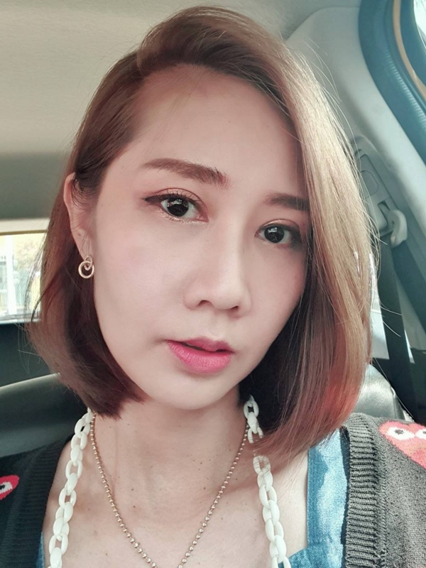 หลังทำตาสองชั้น+เปิดหัวตา 1 เดือน ชั้นตาดูเข้าที่ ยุบบวมลงมากๆ