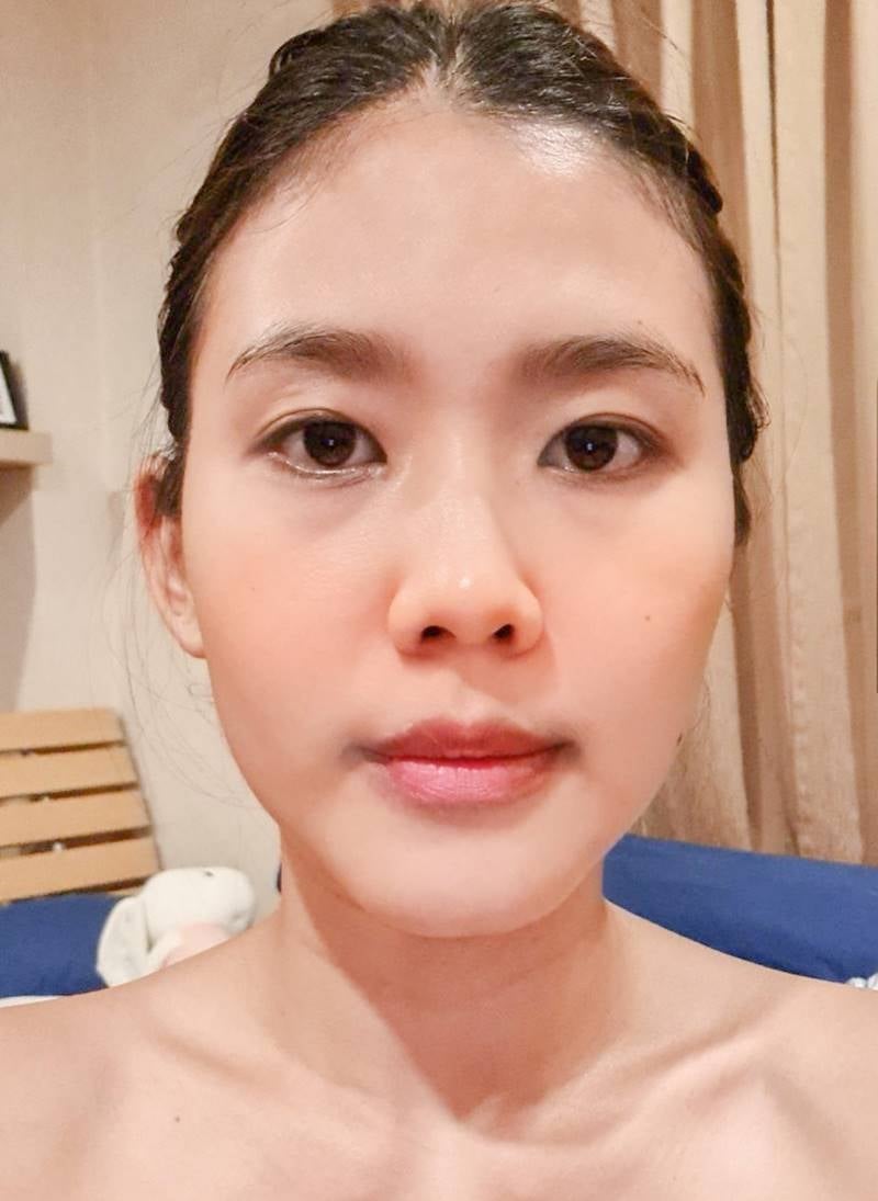 ก่อนทำตาสองชั้น เปิดหัวตา มีปัญหาตาไม่เท่ากัน ชั้นตาหลบใน