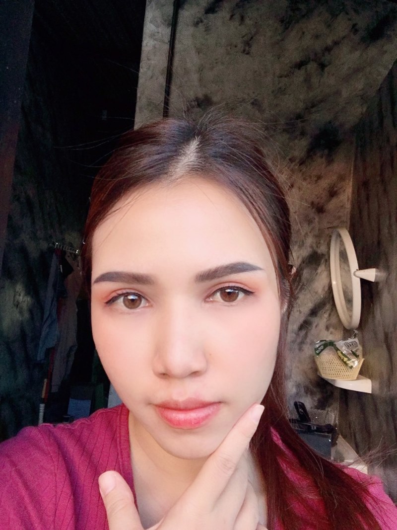 หลังทำตาสองชั้น+เปิดหัวตา 3 เดือน