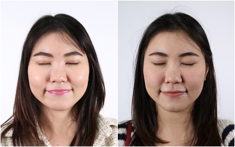 หลังทำตาสองชั้น เปิดหัวตา 13 วัน เปรียบเทียบกับหลังทำตา 4 เดือน