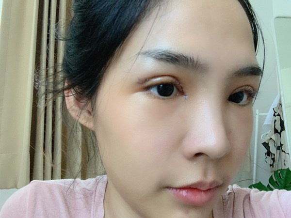 หลังทำตาสองชั้น + เปิดหัวตา 3 วัน ตาโตขึ้น ตาดูเรียวยาว สดใสขึ้น