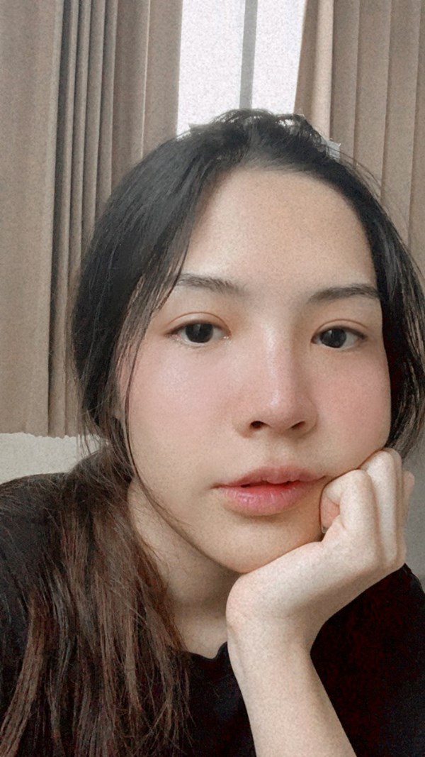 หลังทำตาสองชั้น + เปิดหัวตา 1 เดือน แผลสวยตั้งแต่วันแรกๆ 1 เดือน ชั้นตาเข้าที่และดูธรรมชาติ