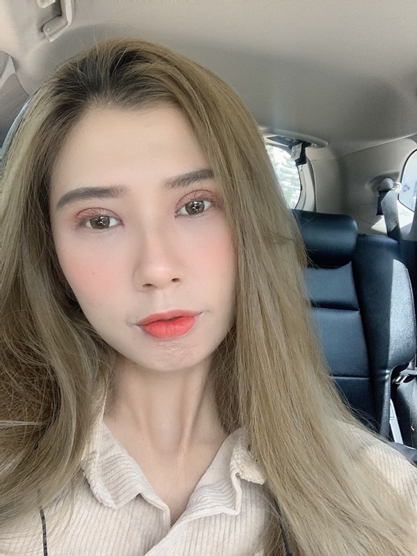 หลังศัลยกรรมตาสองชั้น+เปิดหัวตา 1 เดือน ตาหวานมาก 