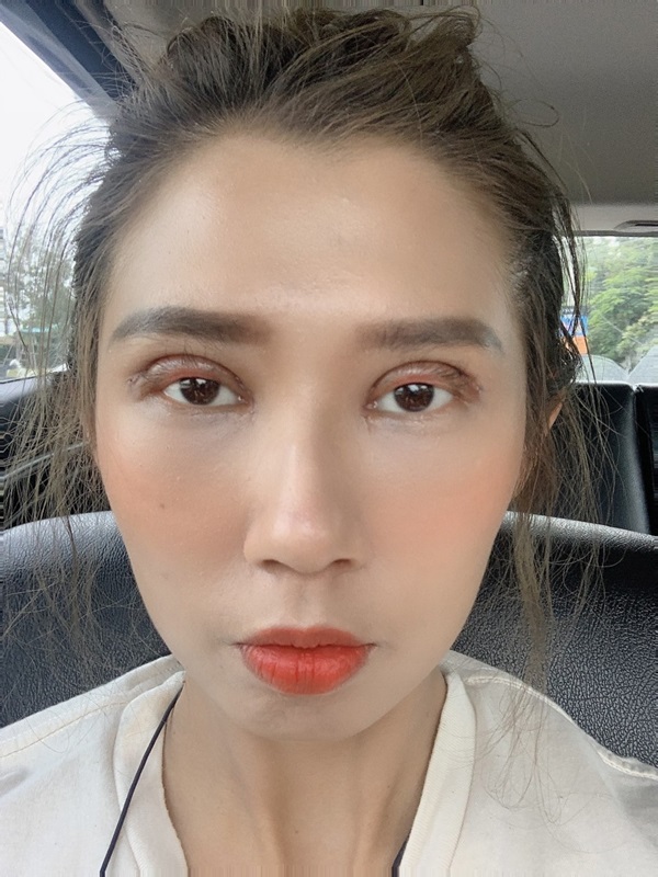 หลังศัลยกรรมตาสองชั้น+เปิดหัวตา 10 วัน ไม่มีความรู้สึกเจ็บเลยค่ะ ตาก็เริ่มเข้าที่มากขึ้น