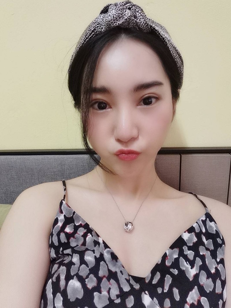 หลังทำตาสองชั้น+เปิดหัวตา 12 วัน เพิ่งตัดไหม เห็นชั้นตาชัด