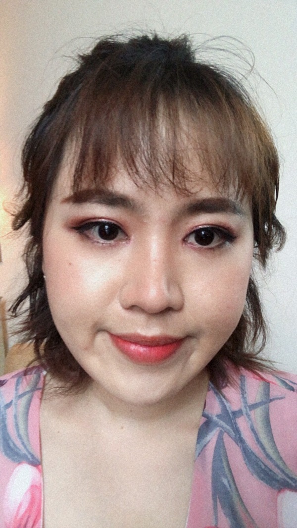 หลังทำตาสองชั้น+เปิดหัวตา 1 เดือน ชั้นตาที่ได้เท่ากัน