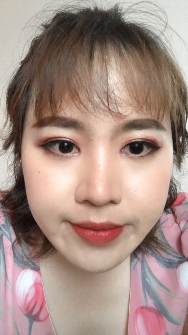 หลังทำตาสองชั้น+เปิดหัวตา 1 เดือน ชั้นตาเท่ากัน หัวตาดูเปิดกว้าง ตาได้สัดส่วน