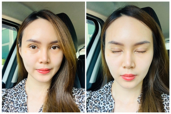 หลังศัลยกรรมตาสองชั้น+เปิดหัวตา ชั้นตาสวยคมชัดเจน