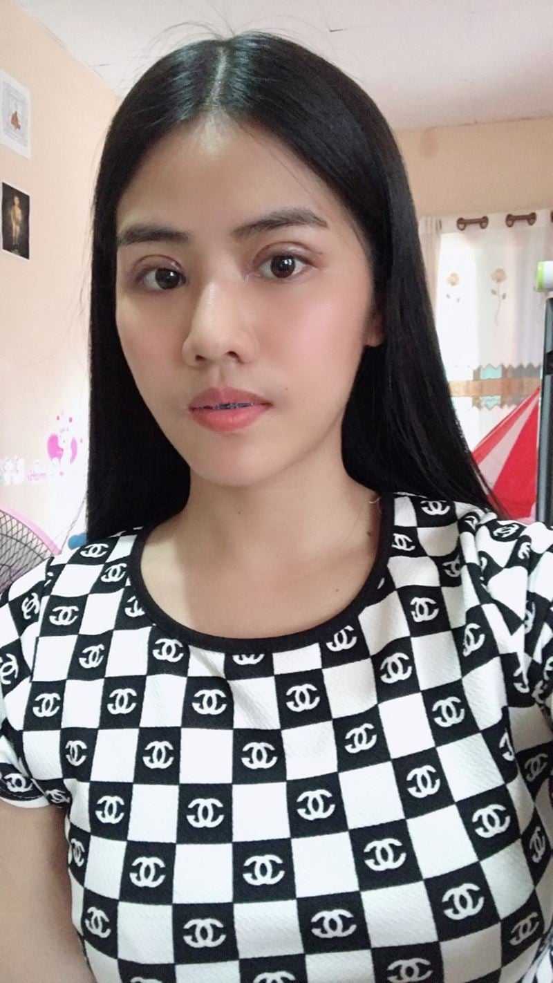 หลังทำตาสองชั้น + เปิดหัวตา 7 วัน ชั้นตาโค้งสวย ขนานไปกับแนวขนตา
