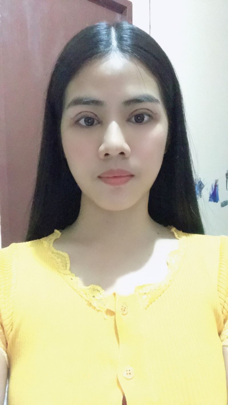 หลังทำตาสองชั้น + เปิดหัวตา 3 วัน ชั้นตาชัดเจน