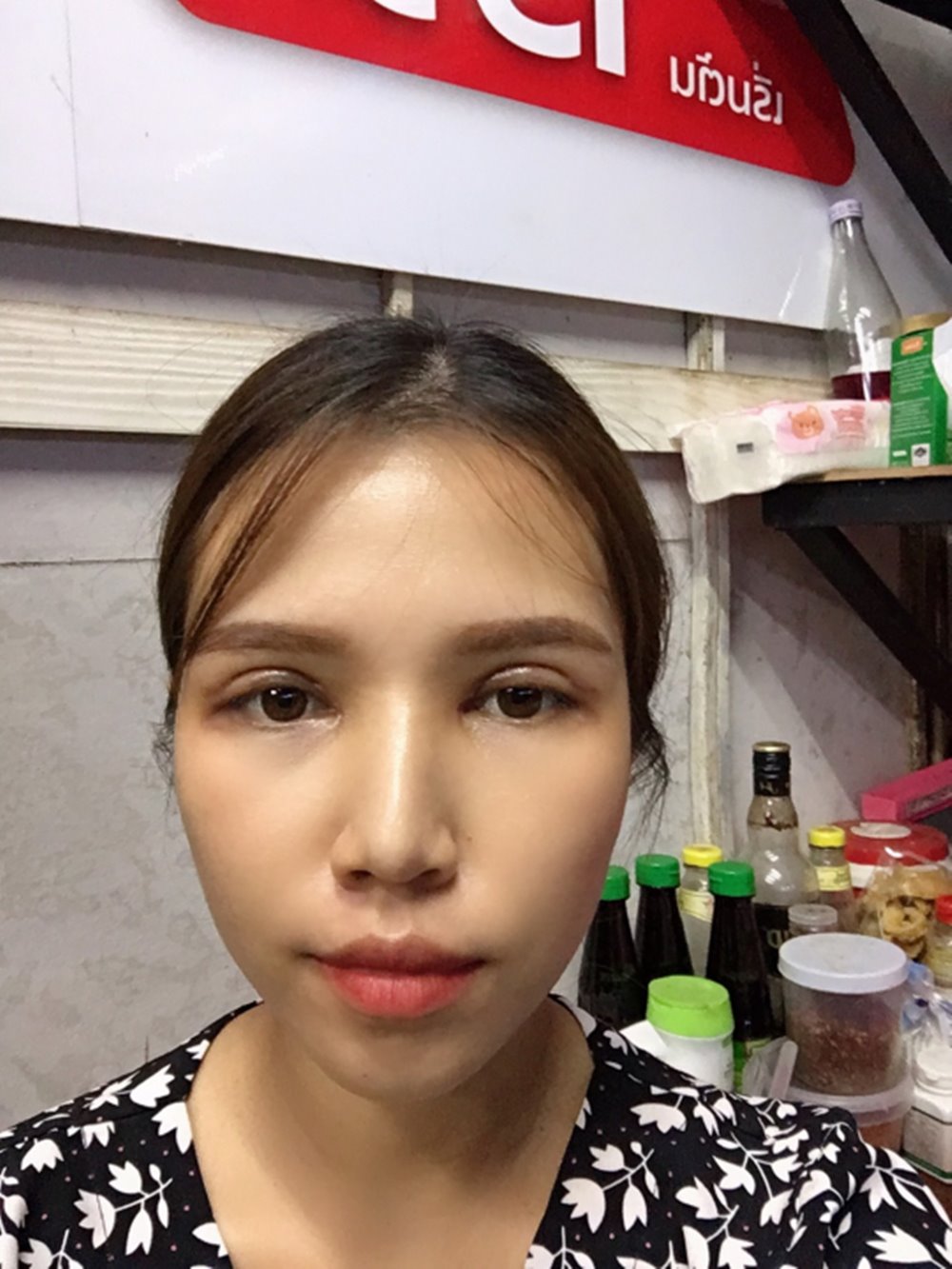 หลังทำตาสองชั้น+เปิดหัวตา 10 วัน