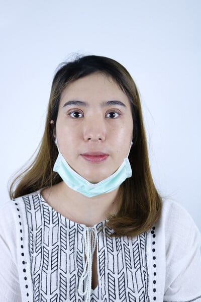 หลังทำตาสองชั้น 10 วัน ชั้นตาพับตามรอยดี