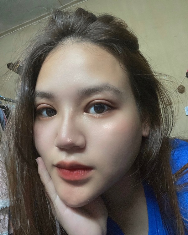 การทำตาสองชั้น ช่วยแก้ปัญหาตาชั้นเดียวหลบใน ตาสองชั้นหลบใน ตาเล็ก ตาชั้นเดียว ตาตก ตาไม่เท่ากัน