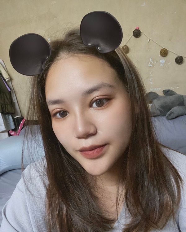 ทำตาสองชั้น ไม่ใช่แค่มีชั้นตาอย่างเดียว แต่ยังแก้ปัญหาของเราได้เยอะ แก้ไขหนังตาตก ชั้นตาหลบใน