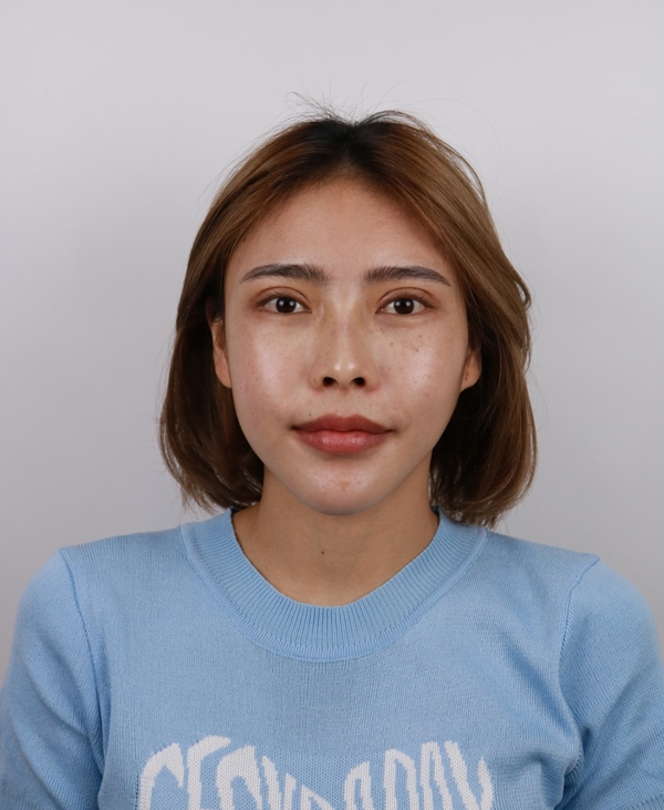 ทำตาสองชั้น+ดึงกล้ามเนื้อตา+เปิดหัวตา 23_6_23 (6).JPG