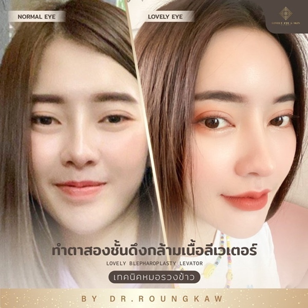 ดึงกล้ามเนื้อตาลีเวเตอร์