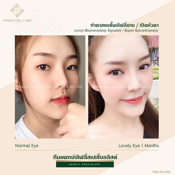 เคสทำตาสองชั้น เปิดหัวตาเทคนิคหมอรวงข้าว