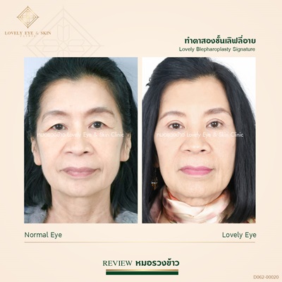ทำตาสองชั้นเทคนิคหมอรวงข้าว 1 (6).jpg