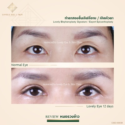 ทำตาสองชั้นเทคนิคหมอรวงข้าว 1 (7)_0.jpg