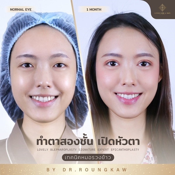 ทำตาสองชั้นพร้อมตกแต่งหนังตาส่วนเกิน