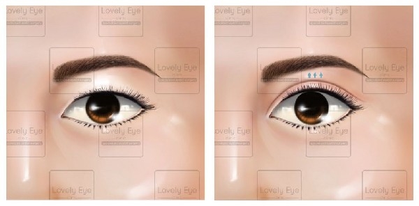 ทำตาสองชั้นแบบดึงกล้ามเนื้อตาลีเวเตอร์ Lovely Blepharoplasty Levator