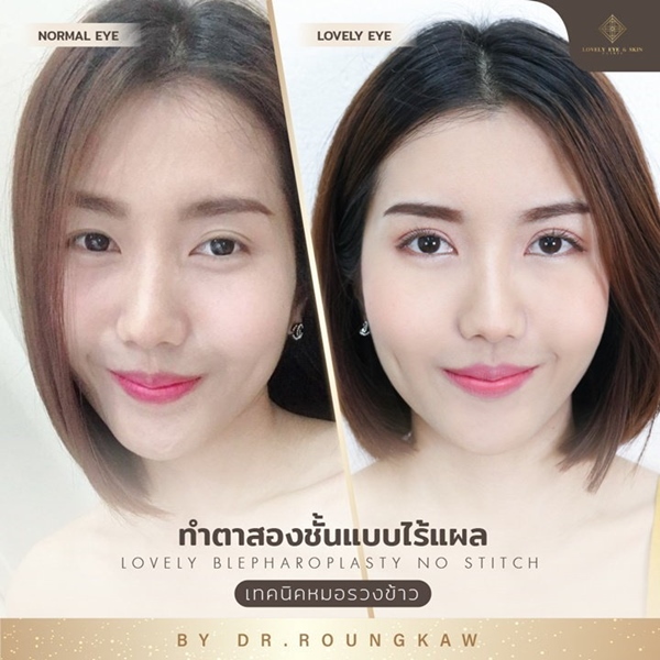 ทำตาสองชั้น แบบไร้รอยเย็บ