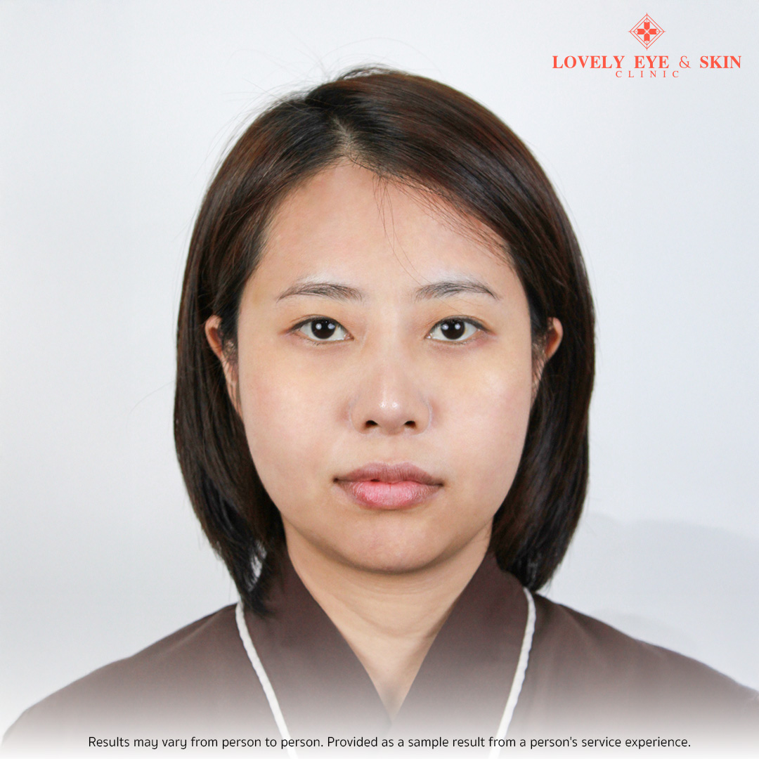 before revision blepharoplasty