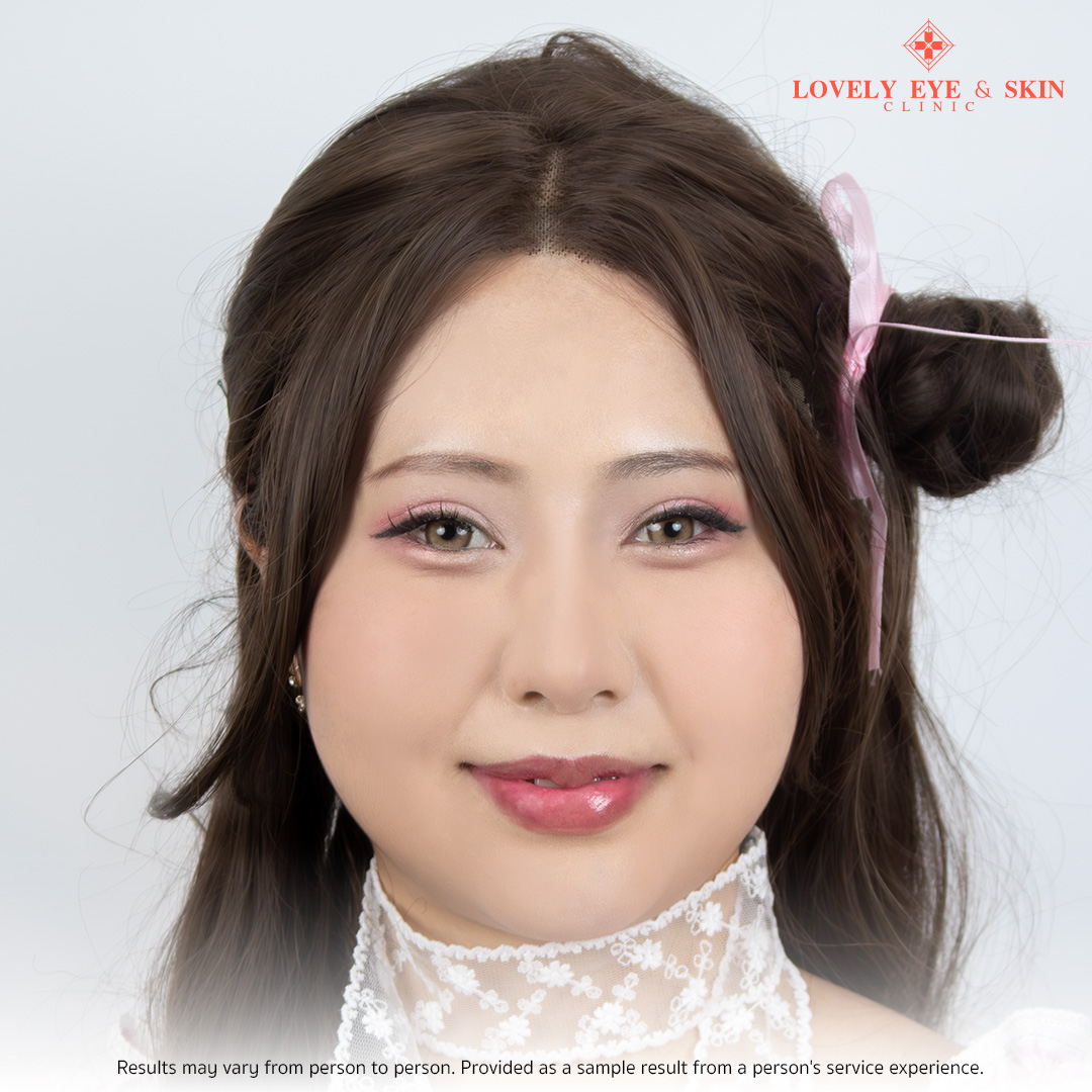 After revision blepharoplasty