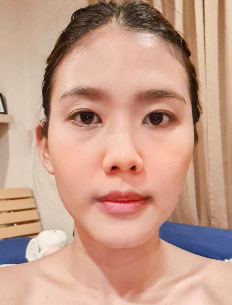 ปัญหาตาก่อนทำ ชั้นตาหลบใน