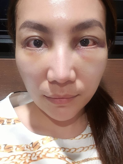 หลังตัดถุงใต้ตา 5 วัน