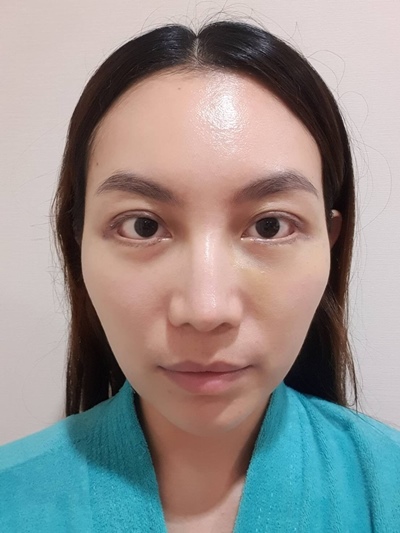 หลังตัดถุงใต้ตา 12 วัน