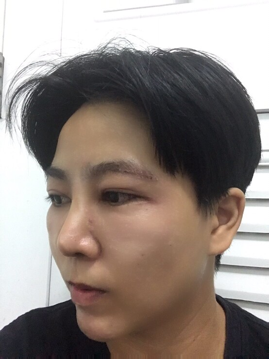 ยกหางตาซ่อนแผลใต้คิ้ว เทคนิคหมอรวงข้าว 6 (3).jpg